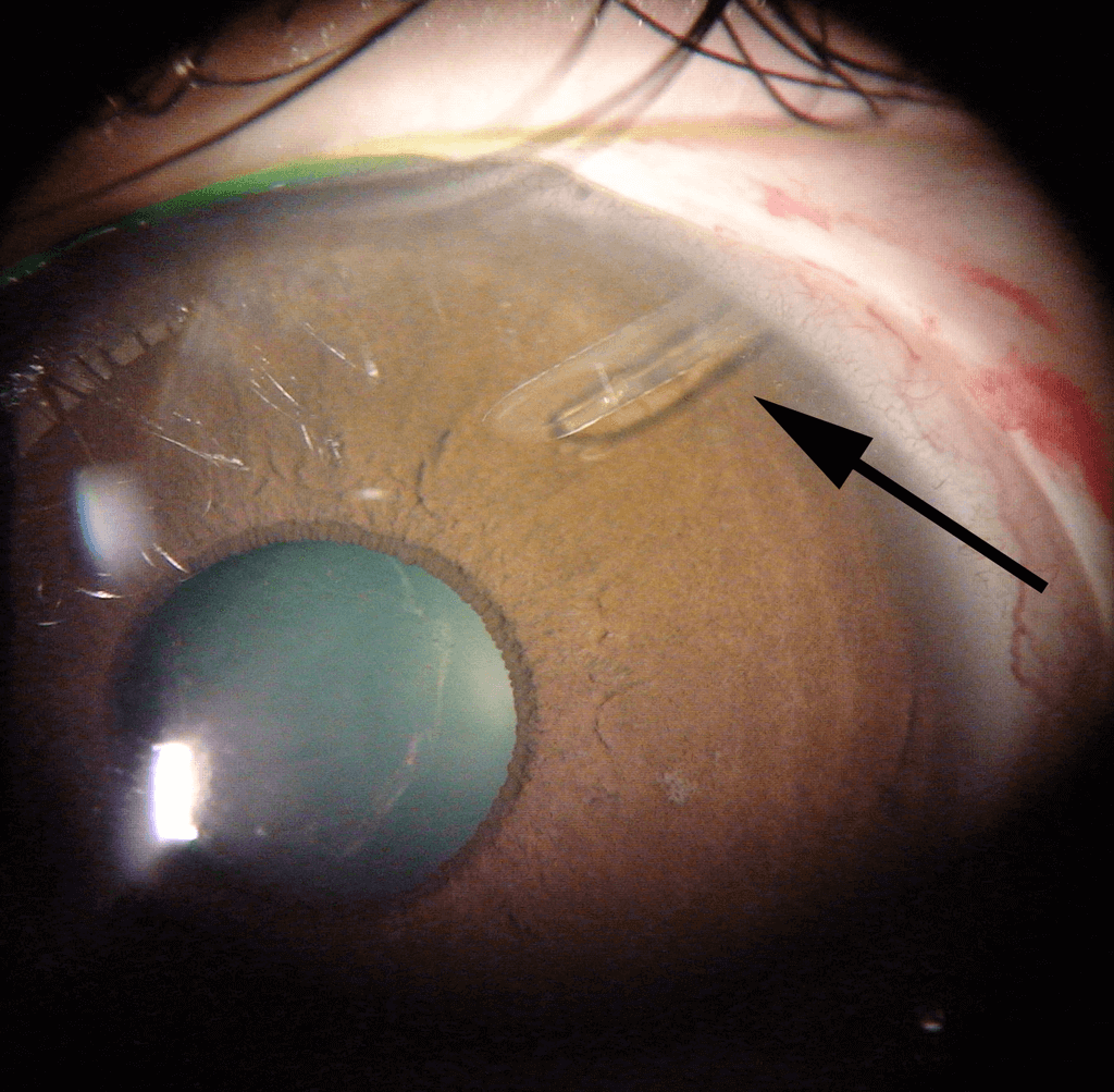 Clinical view of an eye with an aqueous shunt tube in place