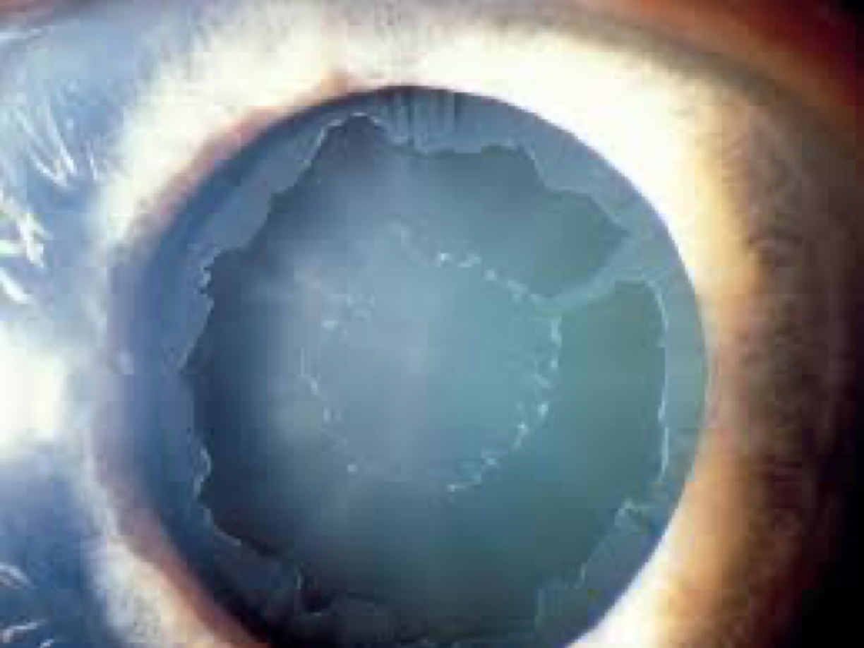 Clinical photograph of the eye in pigmentary glaucoma