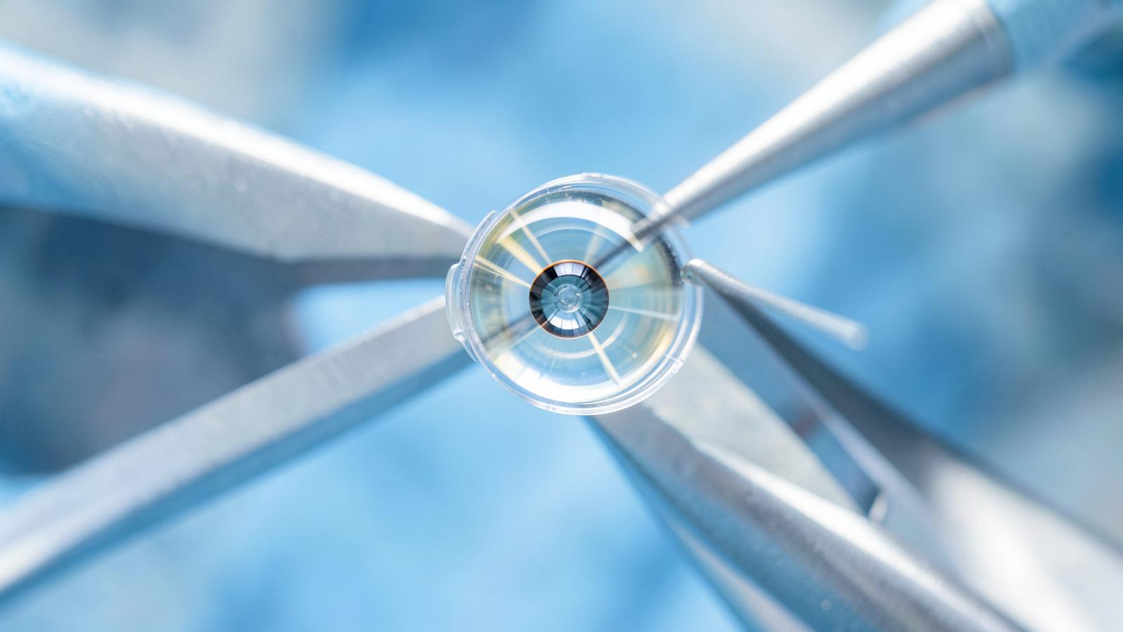 Light-adjustable lenses: fine-tuning vision after cataract surgery